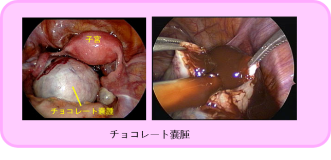 チョコレート 嚢胞 破裂